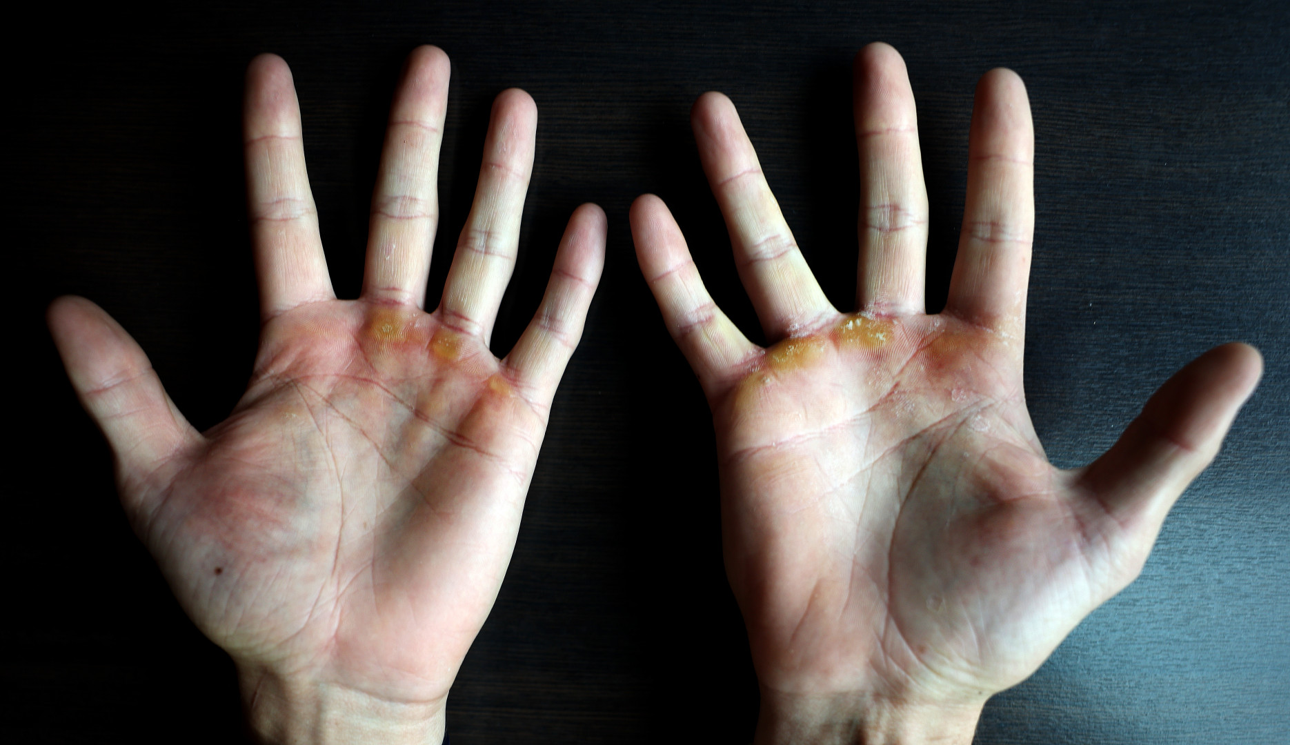 Close-up photograph of Armand Duplantis' hands showing calluses.