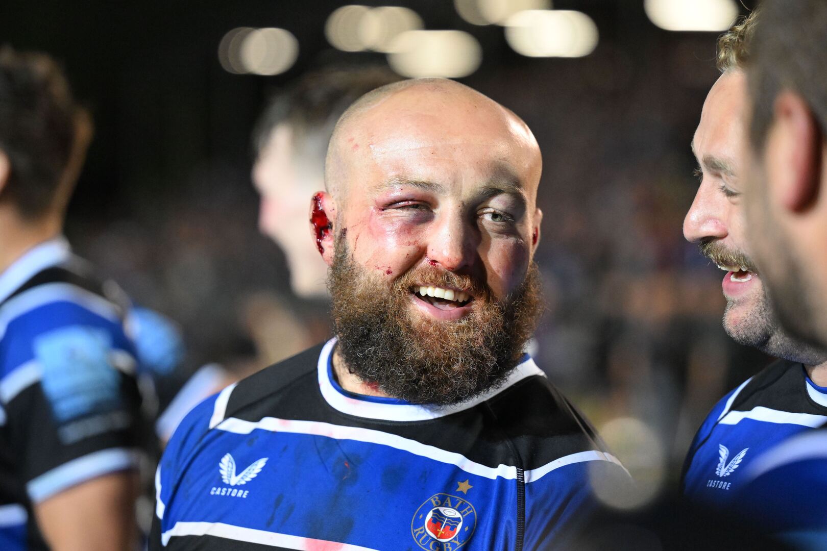 Tom Dunn of Bath Rugby after a match, with visible injuries.